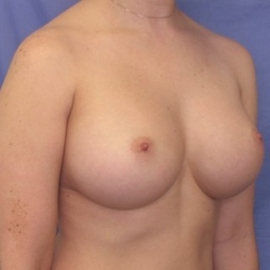 Breast Augmentation Patient 27910 After Photo # 4