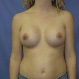 Breast Procedures Patient 23767