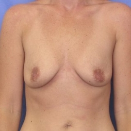 Breast Augmentation Patient 98047 Before Photo Thumbnail # 1