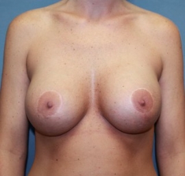 Breast Augmentation Patient 36542 After Photo Thumbnail # 2
