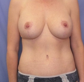Breast Augmentation Patient 72458