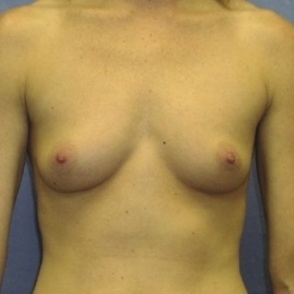 Breast Procedures Patient 32712 Before Photo # 1