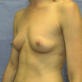 Breast Procedures Patient 32712 Before Photo Thumbnail # 3