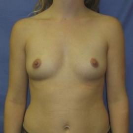 Breast Procedures Patient 23767