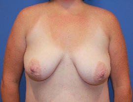 Breast Procedures Patient 96264 Before Photo # 1
