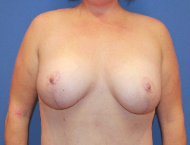 Breast Lift Patient