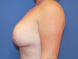 Breast Procedures Patient 96264 After Photo Thumbnail # 6
