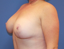 Breast Procedures Patient 96264 After Photo # 4