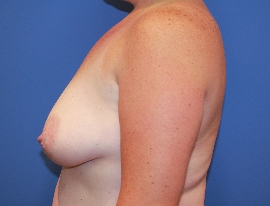 Breast Procedures Patient 96264 Before Photo # 5