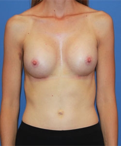 Breast Procedures Patient 95121 After Photo # 2