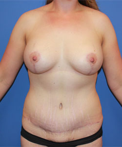Breast Augmentation Patient