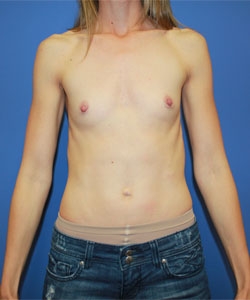 Breast Procedures Patient 95121 Before Photo Thumbnail # 1