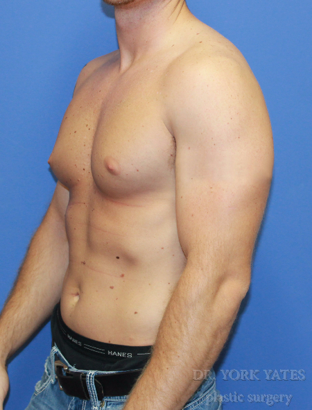 Male Breast Reduction Patient