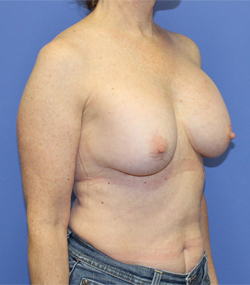 Breast Revision - (Breast Redo) Patient
