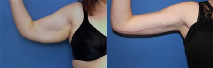 ThermiTight Skin Tightening Salt Lake City | Skin Tightening Layton Utah Dr York Yates