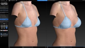 breast augmentation 3d imaging