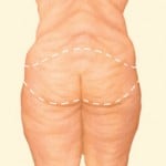 Plastic Surgery After Massive Weight Loss Salt Lake City & Layton Utah
