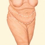 Plastic Surgery After Massive Weight Loss Salt Lake City & Layton Utah