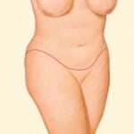 Plastic Surgery After Massive Weight Loss Salt Lake City & Layton Utah