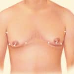 Liposuction incision options
