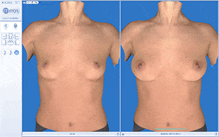 3d breast imaging for augmentation in Utah