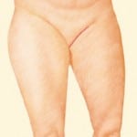 Plastic Surgery After Massive Weight Loss Salt Lake City & Layton Utah