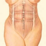 Tummy Tuck Utah