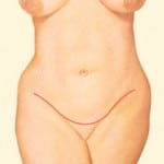 Abdominoplasty Utah