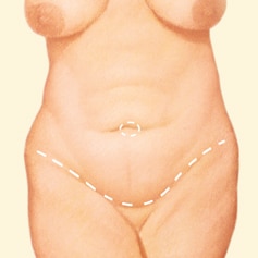 Abdominoplasty Layton UT