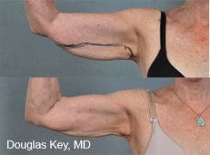ThermiTight Skin Tightening Salt Lake City | Skin Tightening Layton Utah Dr York Yates