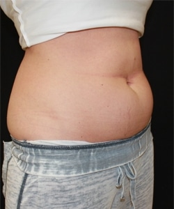 Fat Freezing Layton Utah