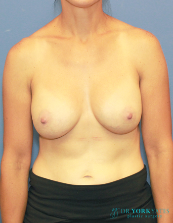 Silicone Breast Augmentation Patient