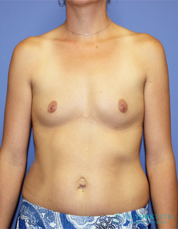 Silicone Breast Augmentation Patient