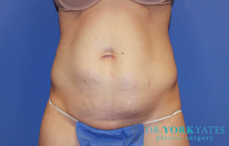 Before Image: Patient # 40152 - front