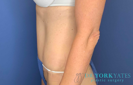 After Image: Patient # 40152 - front