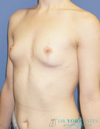 Breast Revision - (Breast Redo) Patient