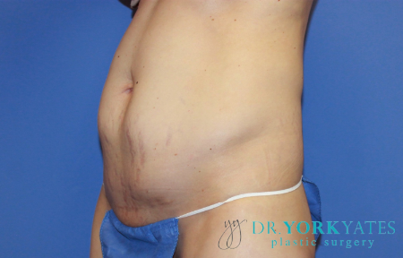 Before Image: Patient # 40152 - front
