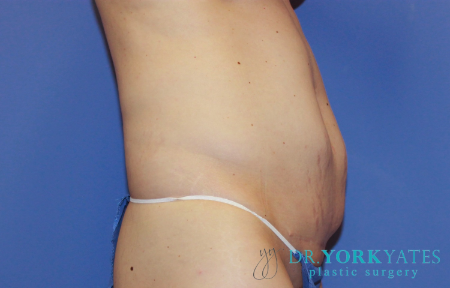 Before Image: Patient # 40152 - front