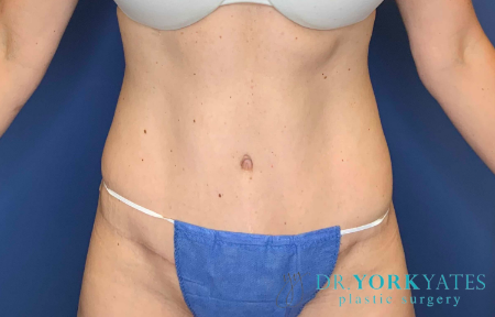 After Image: Patient # 40152 - front
