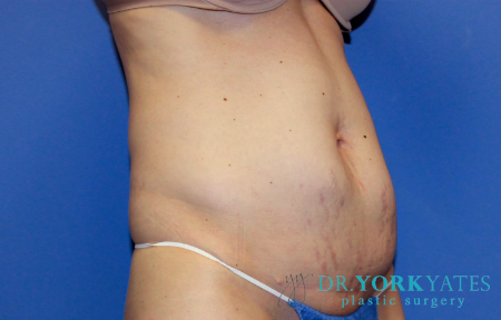 Before Image: Patient # 40152 - front