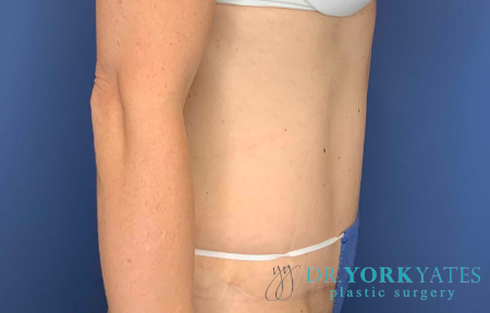 After Image: Patient # 40152 - front