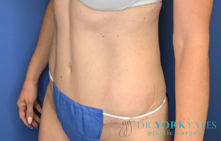 After Image: Patient # 40152 - front