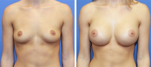 Breast Augmentation Before and After