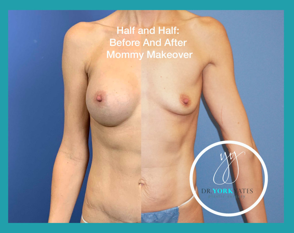 before and after mommy makeover