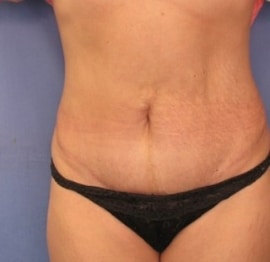Mini Tummy Tuck surgeon Utah