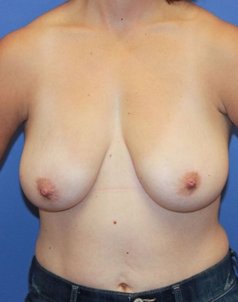 Before and After Breast Lift Salt Lake City