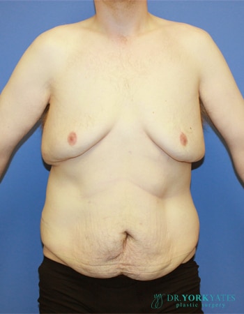 Plastic Surgery After Weight Loss Salt Lake City