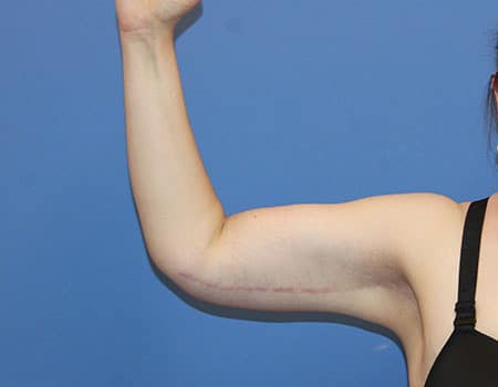 Arm Lift Surgeon Salt Lake City, Utah