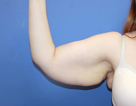 Brachioplasty Surgeon Salt Lake City Utah