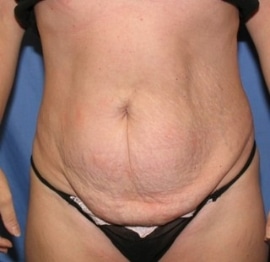 Mini Tummy Tuck surgeon Salt Lake City